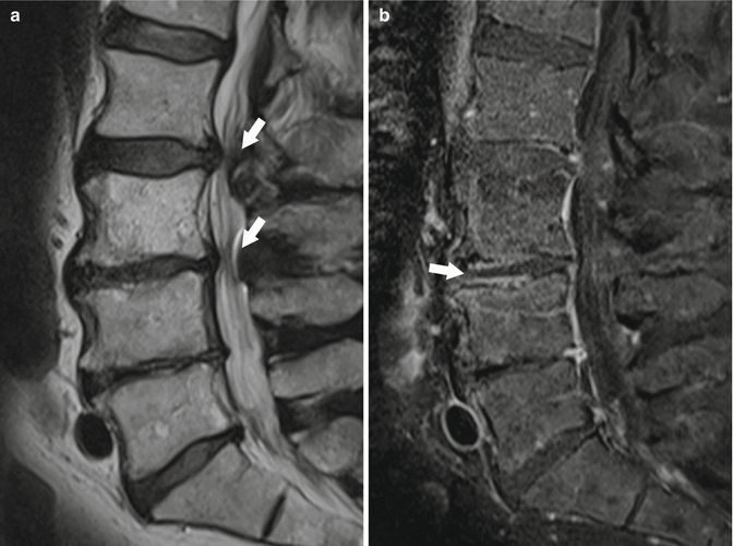 Imaging of Degenerative Disk Disease SpringerLink