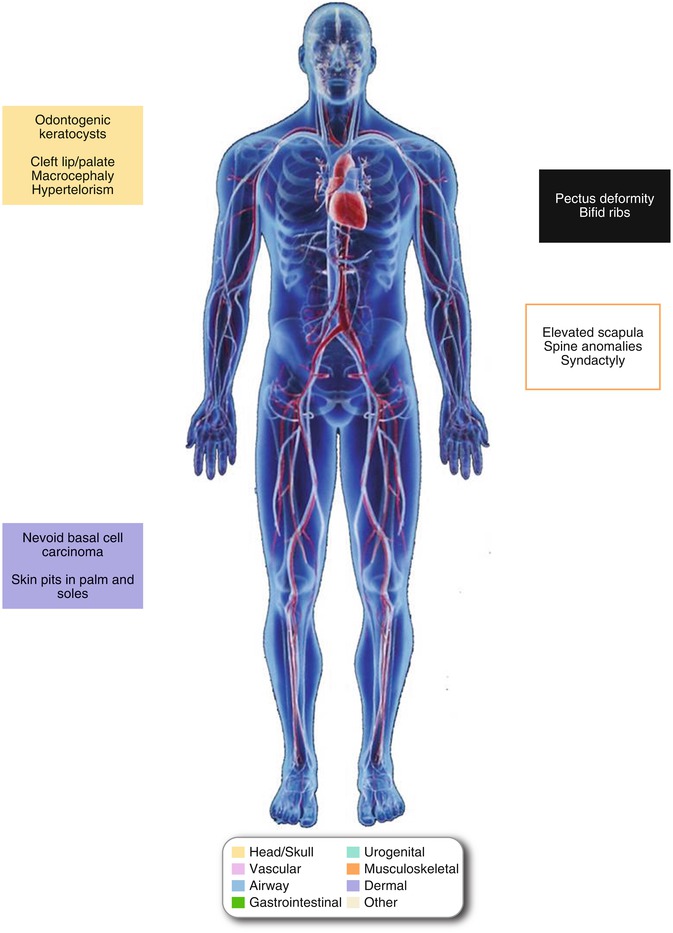 Syndromes Associated with Pectus Deformities | SpringerLink