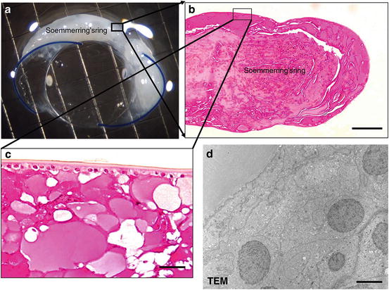 Histology of Posterior Capsular Opacification | SpringerLink