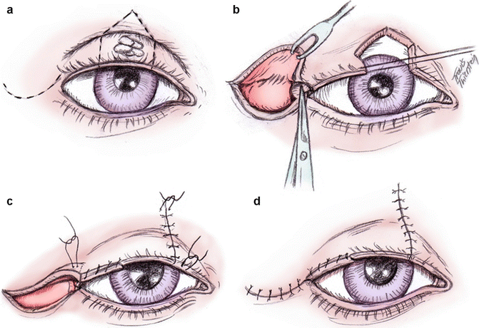 Exposure Keratopathy Due to Absent or Avulsed Eyelids | SpringerLink