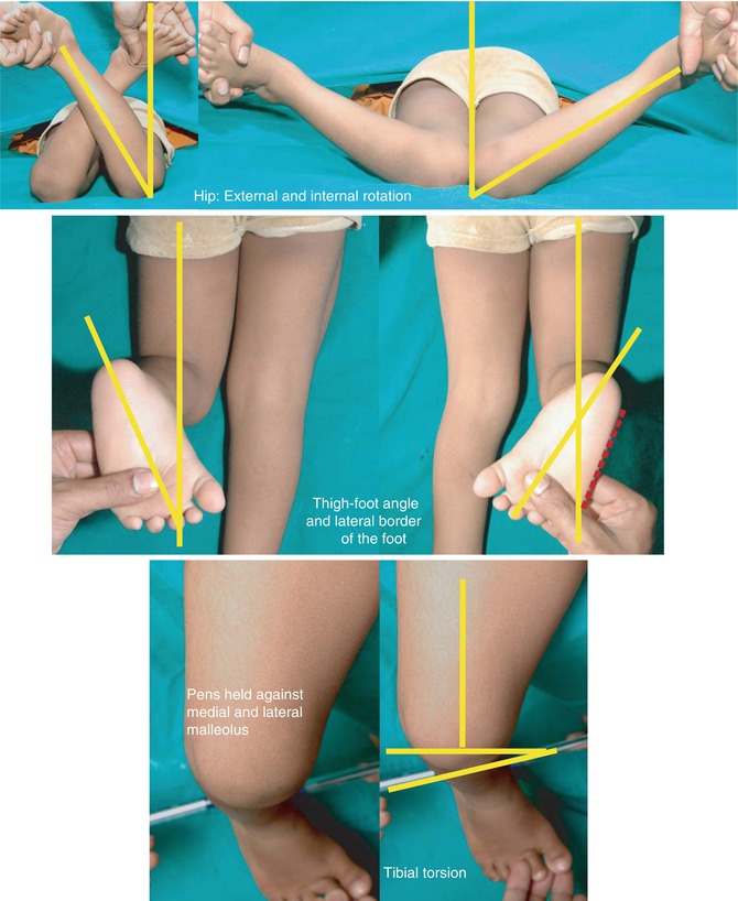 InToeing and OutToeing Gait SpringerLink