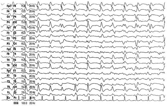 View Creutzfeldt-Jakob Disease Eeg Triphasic Pictures