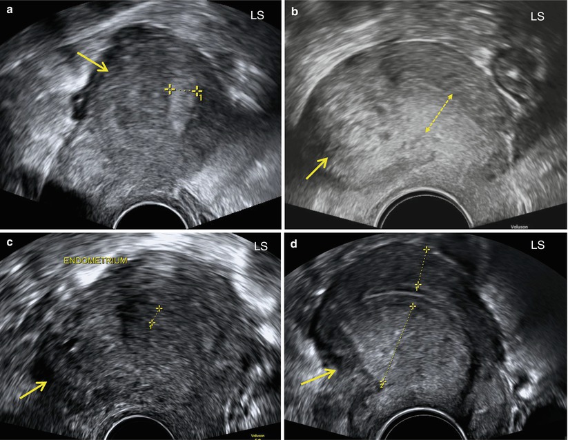 Ultrasound Evaluation of Myometrium | SpringerLink