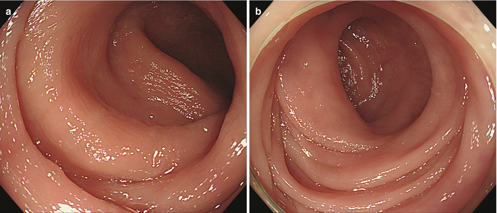 colonoscopy findings colonoscopy findings