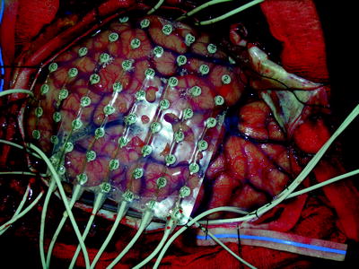 Cortical Mapping Springerlink