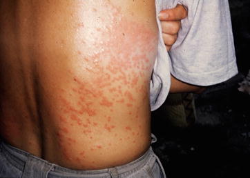 giardia in humans skin