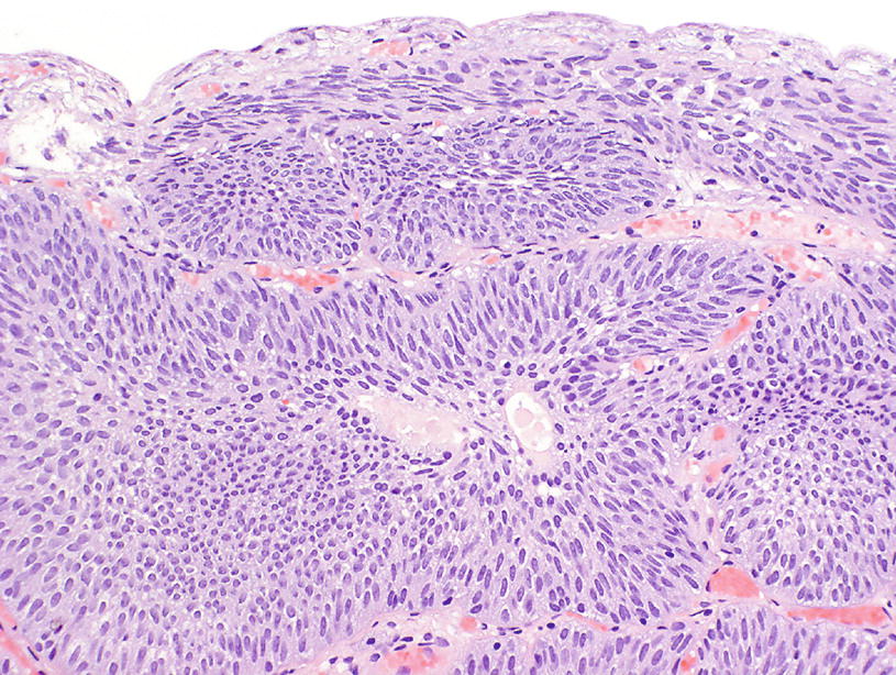 urothelial papilloma with atypia