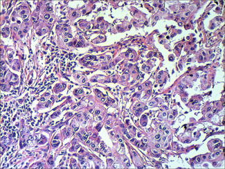 Adenocarcinoma NOS, Salivary Glands of | SpringerLink