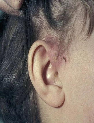 Sinus Preauricular Springerlink