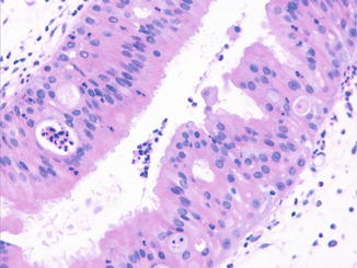 Oncocytic nasal papilloma, Etymology for papilloma
