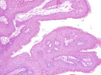 Human papilloma the tongue Hpv on tongue images, HPV human papiloma virus