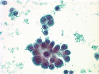 Mesothelial Cells Reactive Springerlink