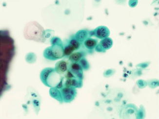 Reactive Cellular Changes Intrauterine Contraceptive Device Springerlink