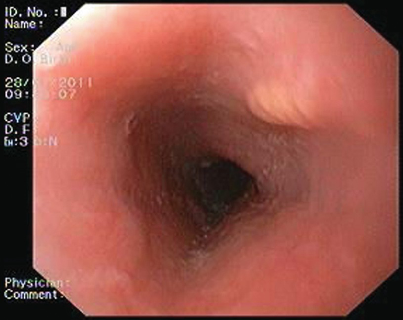 Papilloma esophagus icd 10 Squamous papilloma of esophagus icd 10