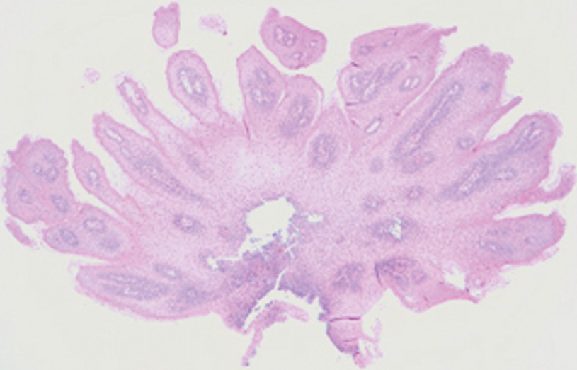 fibro squamous papilloma