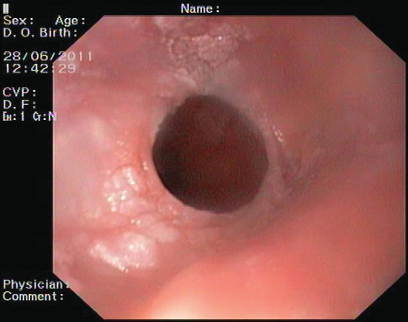 papilloma a vírus gi