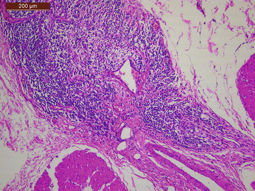 Diversion Colitis Springerlink