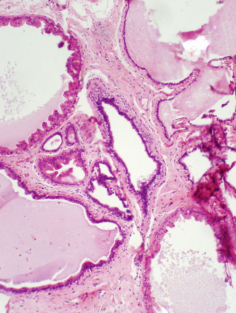 intraductalis papilloma apokrin metaplasia