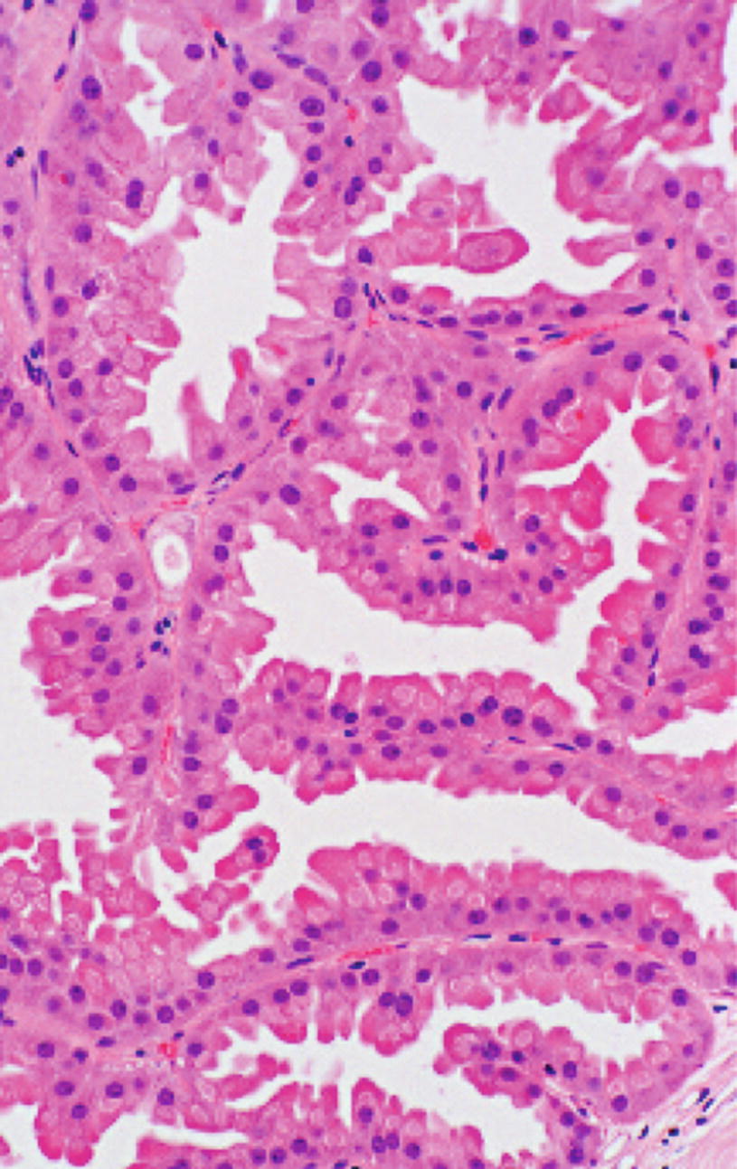 Papillary lesion with atypia