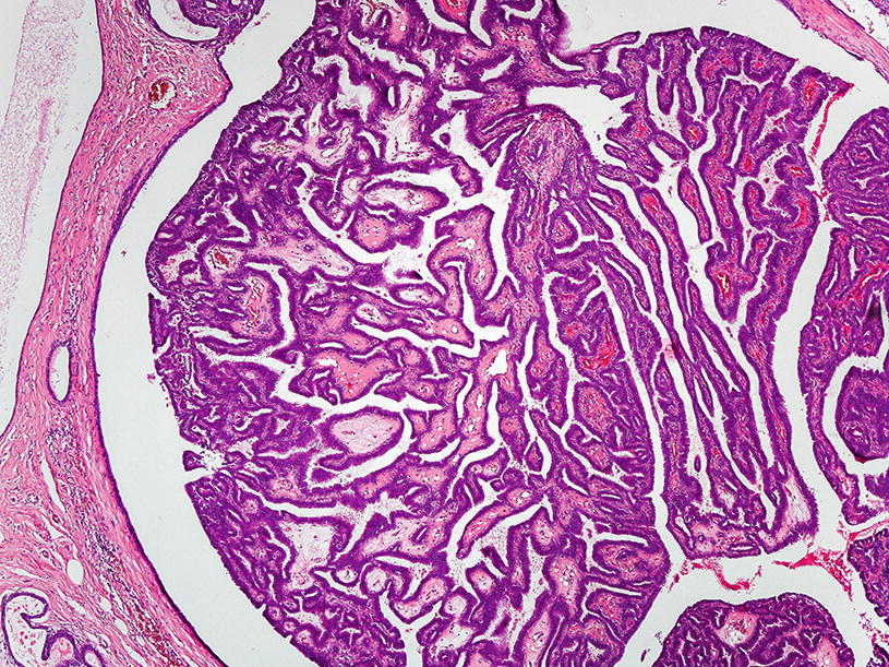 intraductalis papilloma ductalis hyperplasia