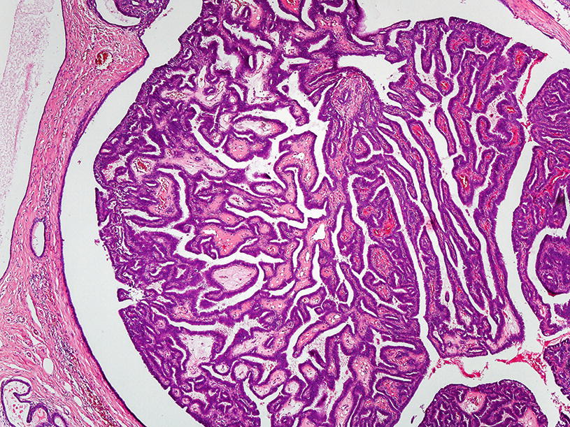 intraductalis papilloma ihc