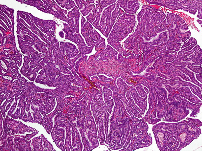 papilloma vs fibroma