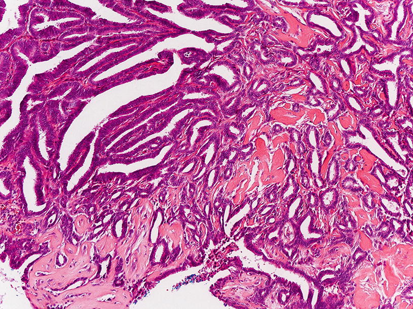 intraductalis papilloma atipikus sejtekkel