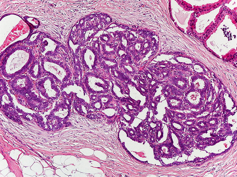Intraductalis papilloma hyperplasia, Intraductalis papilloma - jóindulatú daganat az emlő