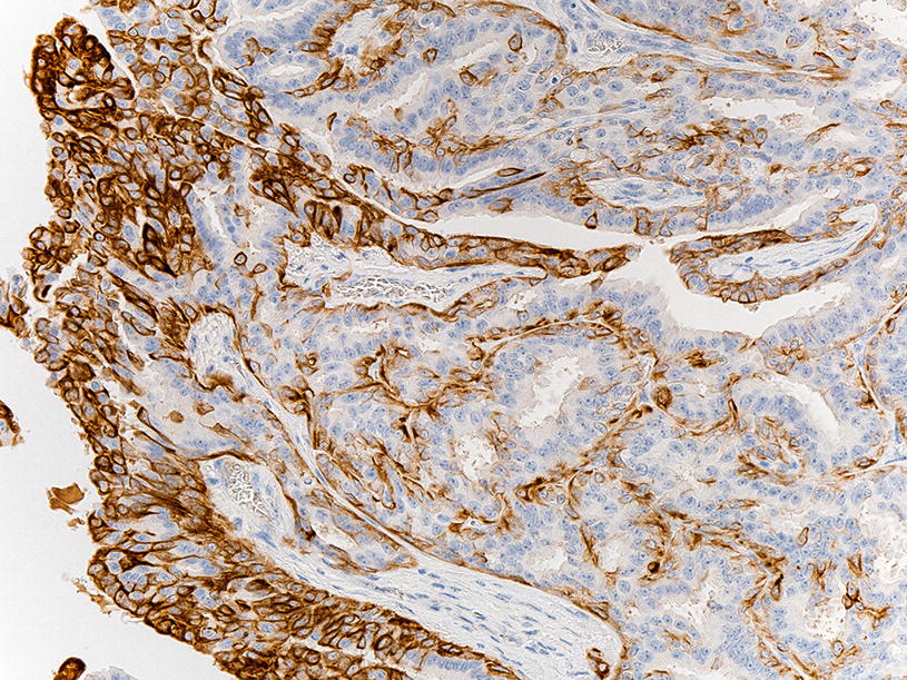 intraductalis papilloma atipikus sejtekkel papilloma vírus és tumor