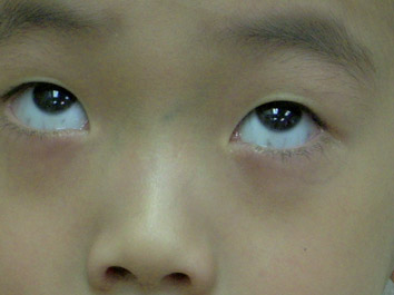 Scleral Melanocytosis Springerlink