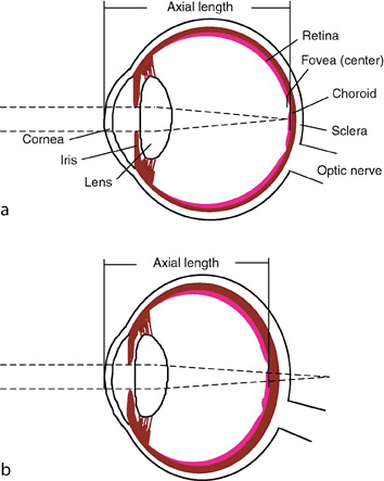 optometrie: Hipermetropia