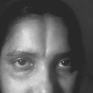 Hyperostosis Frontalis Interna Springerlink