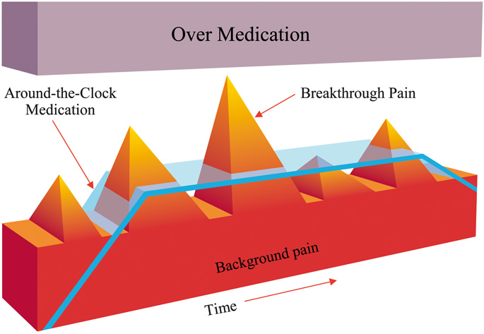 Cancer Pain Management, Cancer-Related Breakthrough Pain, Therapy | SpringerLink Cancer Pain Management, Cancer-Related Breakthrough Pain, Therapy | SpringerLink