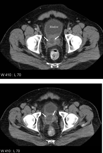 abcès prostate