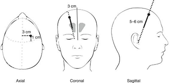 Ventriculostomy Springerlink