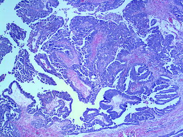 ovarian cancer pathology
