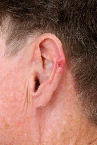 Basal Cell Carcinoma Of Ear Springerlink