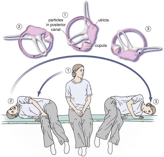 benign paroxysmal positional vertigo benign paroxysmal positional vertigo