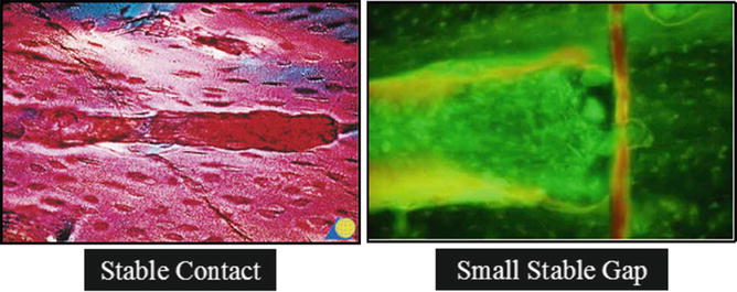 Principles Of Internal Fixation Of Fractures Springerlink