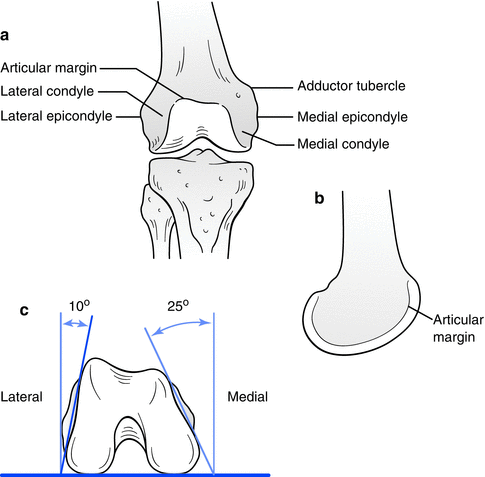 Distal Femur Fractures Springerlink