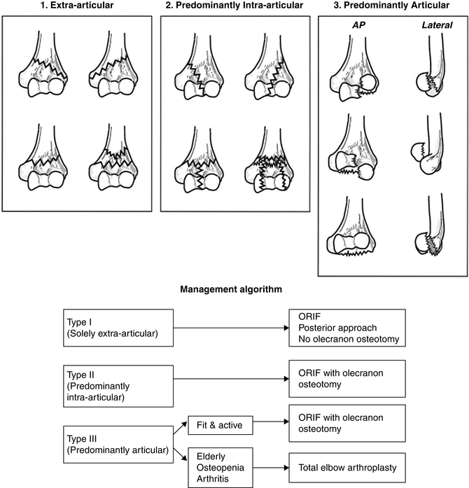 comminuted intra articular fracture distal humerus)