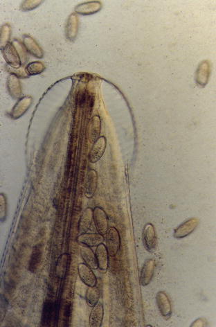 enterobius vermicularis perianal negi neglijate
