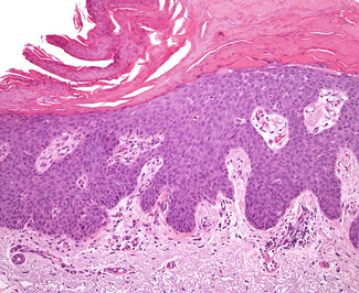 Bowen’s Disease 