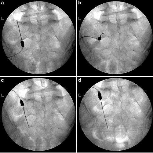 Sacroiliac Joint Radiofrequency Denervation SpringerLink