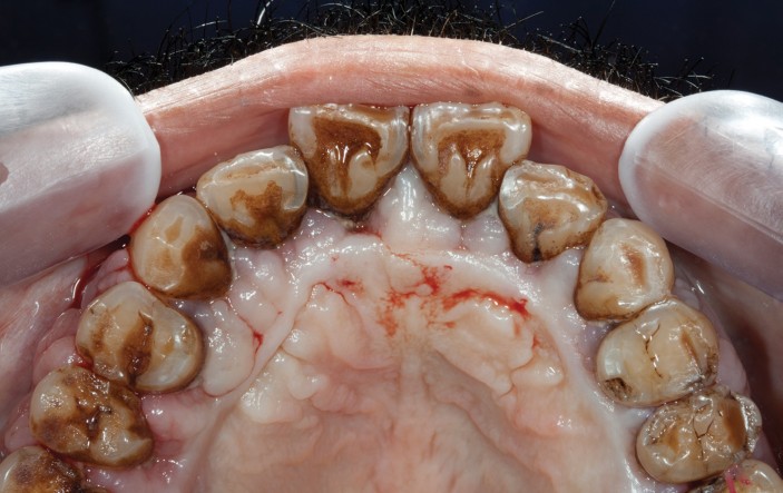 What Is Periodontal Disease Caused By: What Is Periodontal Disease?