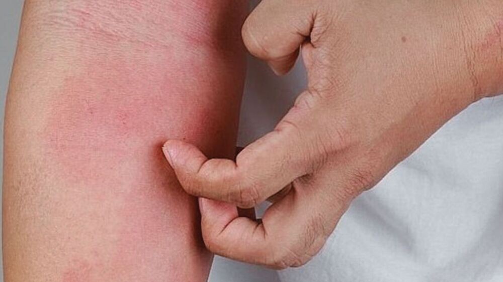 Vortrag Atopische Dermatitis