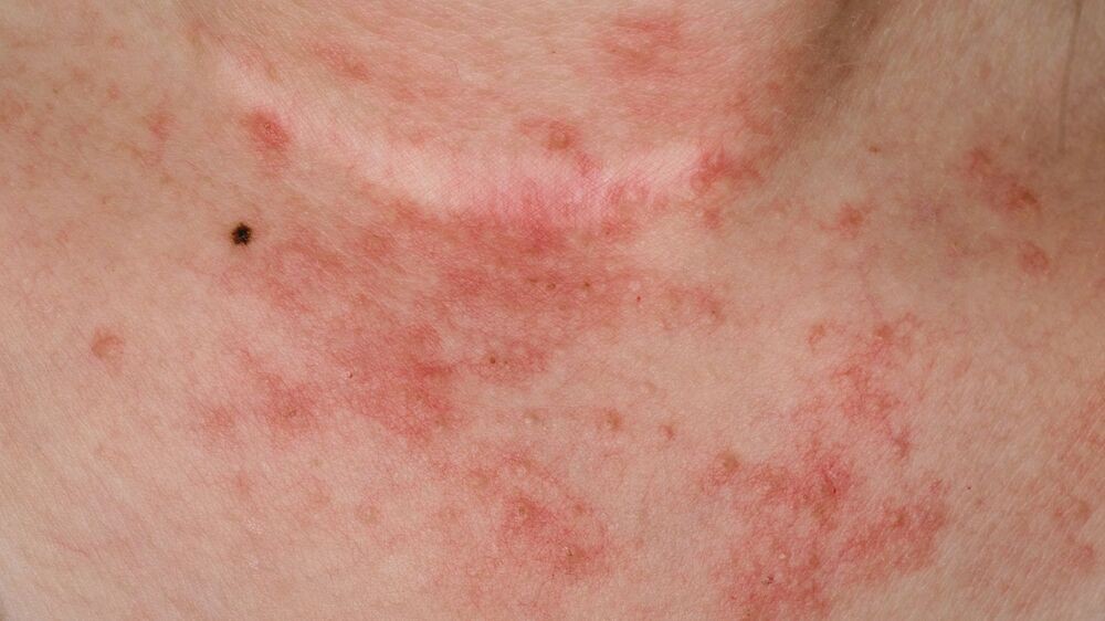 Vortrag Abwehr von Allergenen