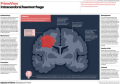 Intracerebral haemorrhage