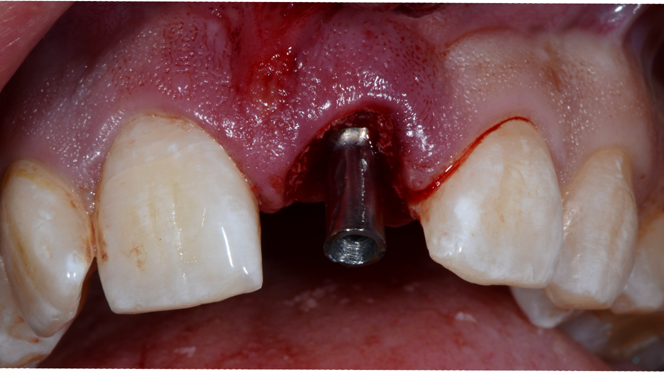 Immediate replacement: minimaal invasief, maximaal effectief!