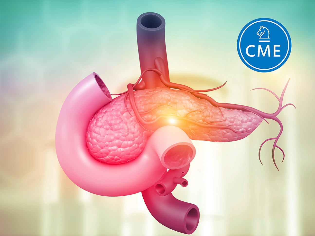 Chronic pancreatitis 3D concept image